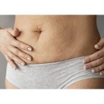 Flacidez após emagrecimento: como prevenir e tratar