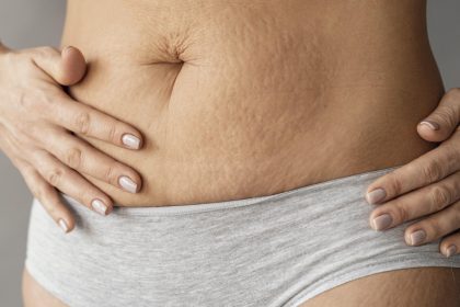 Flacidez após emagrecimento: como prevenir e tratar