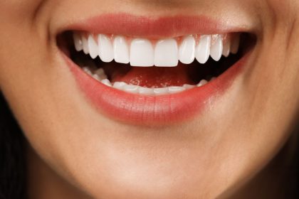 Clareamento dental no verão: mitos e verdades